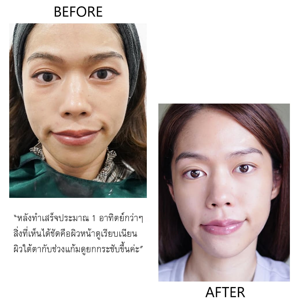 ulthera ยกกระชับ ปรับรูปหน้า
