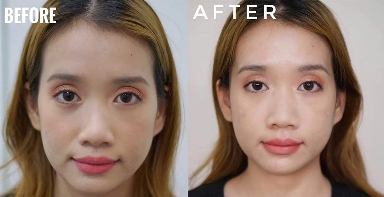 แก้ปัญหาใต้ตาคล้ำ ด้วยการฉีดฟิลเลอร์ใต้ตา 1 cc เห็นความแตกต่างไหม?