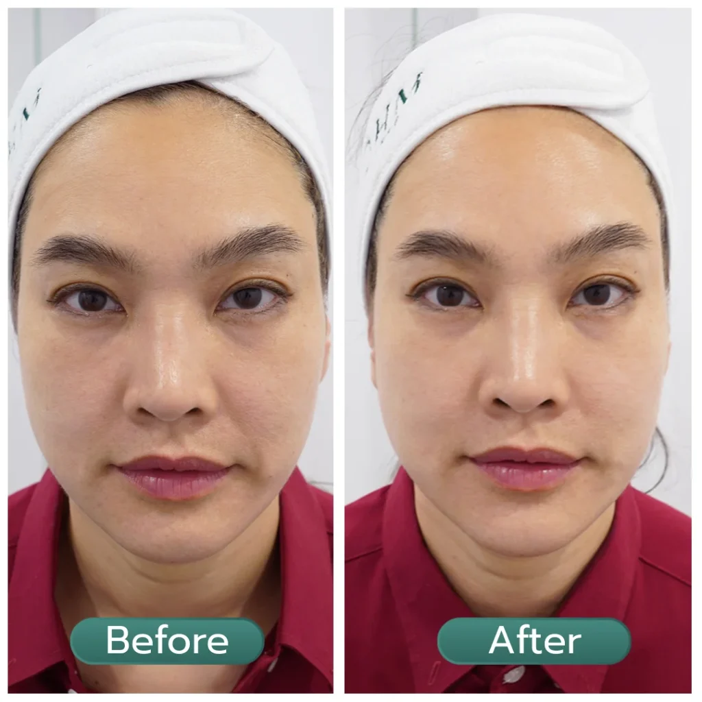 แก้มย้อย