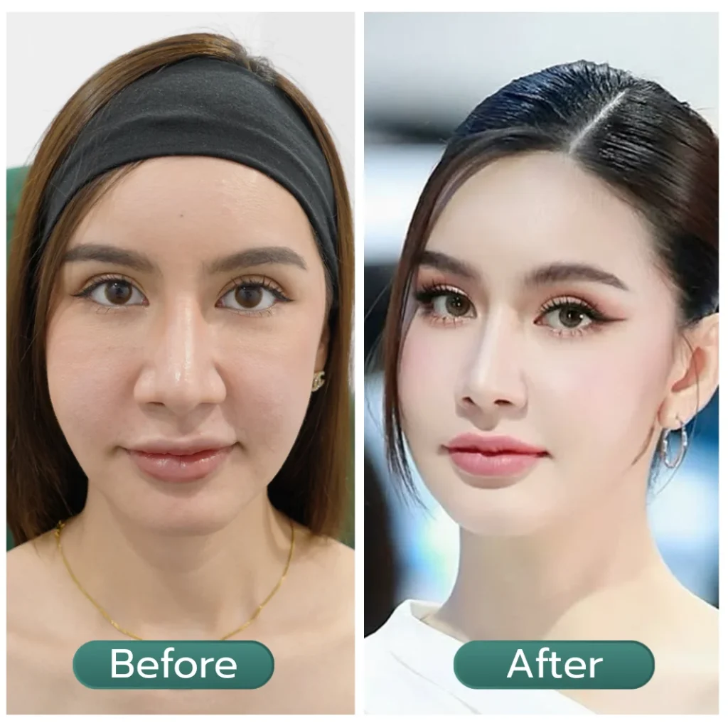 แก้มย้อย