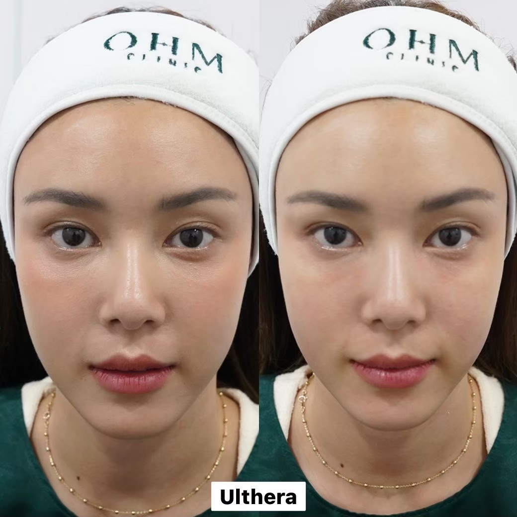 รีวิว Ultherapy