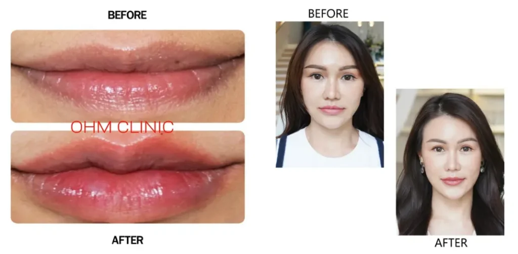 รีวิวฉีดปากกระจับ