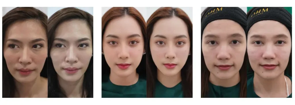 รีวิวฉีดฟิลเลอร์ใต้ตา