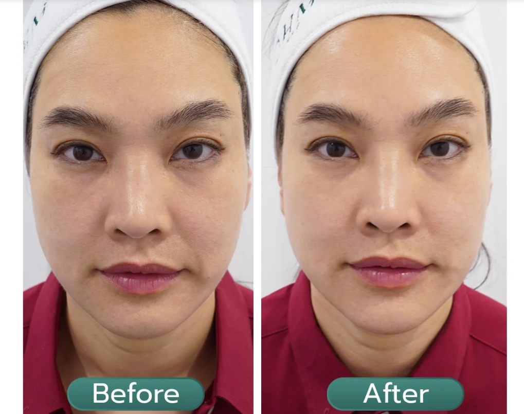 รีวิวกระชับหน้า