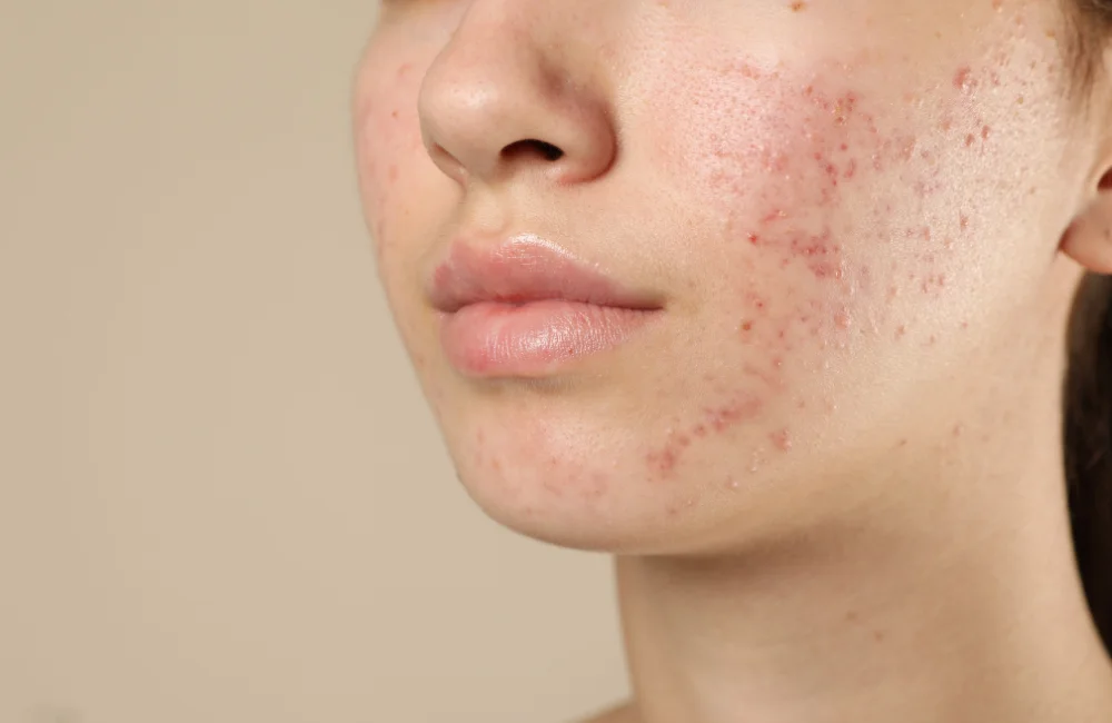 หลุมสิว