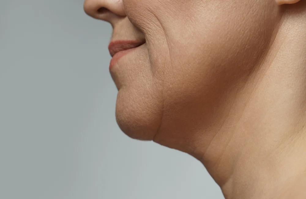 แก้มย้อย