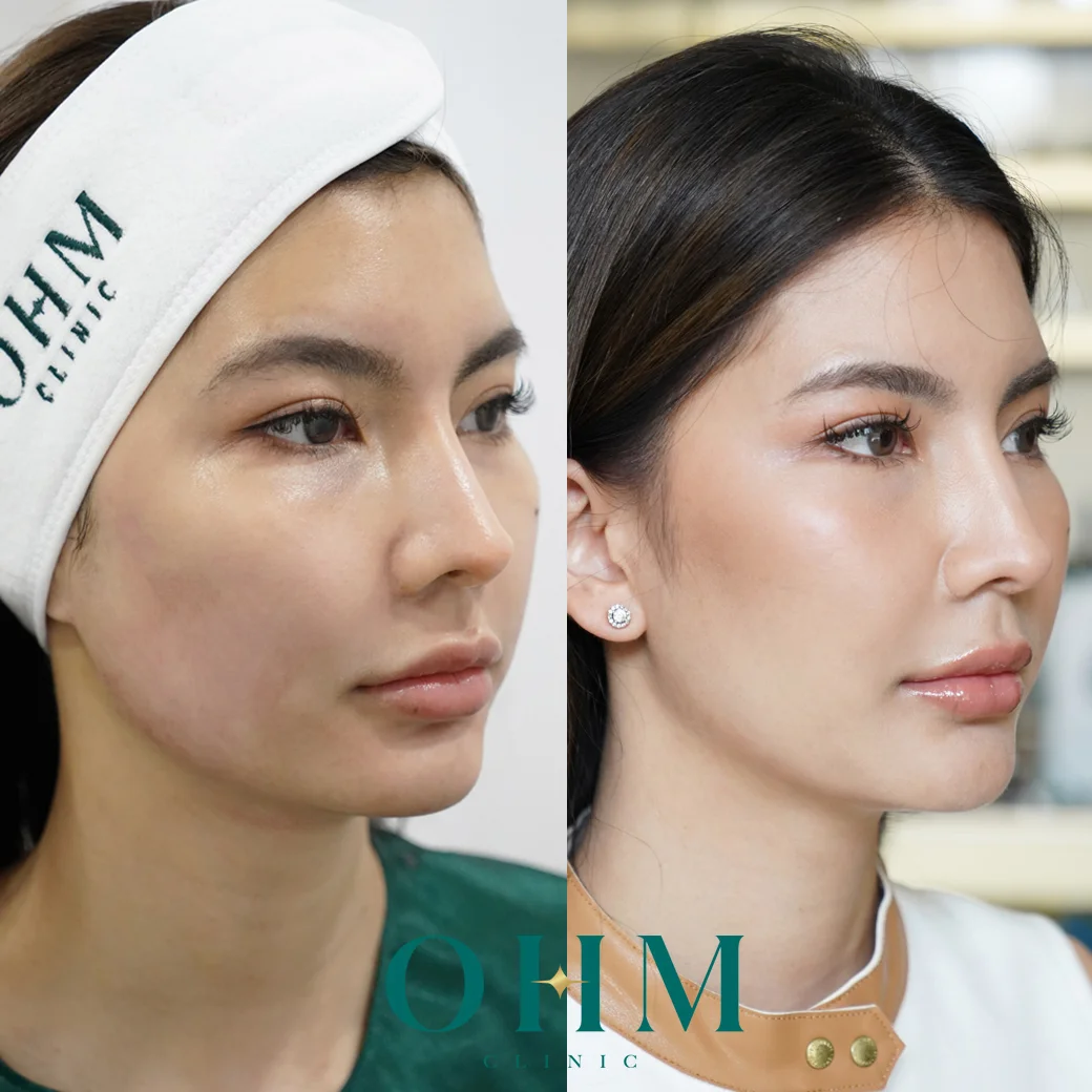รีวิว Ulthera