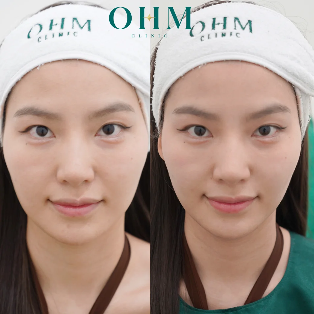 รีวิว oligio x