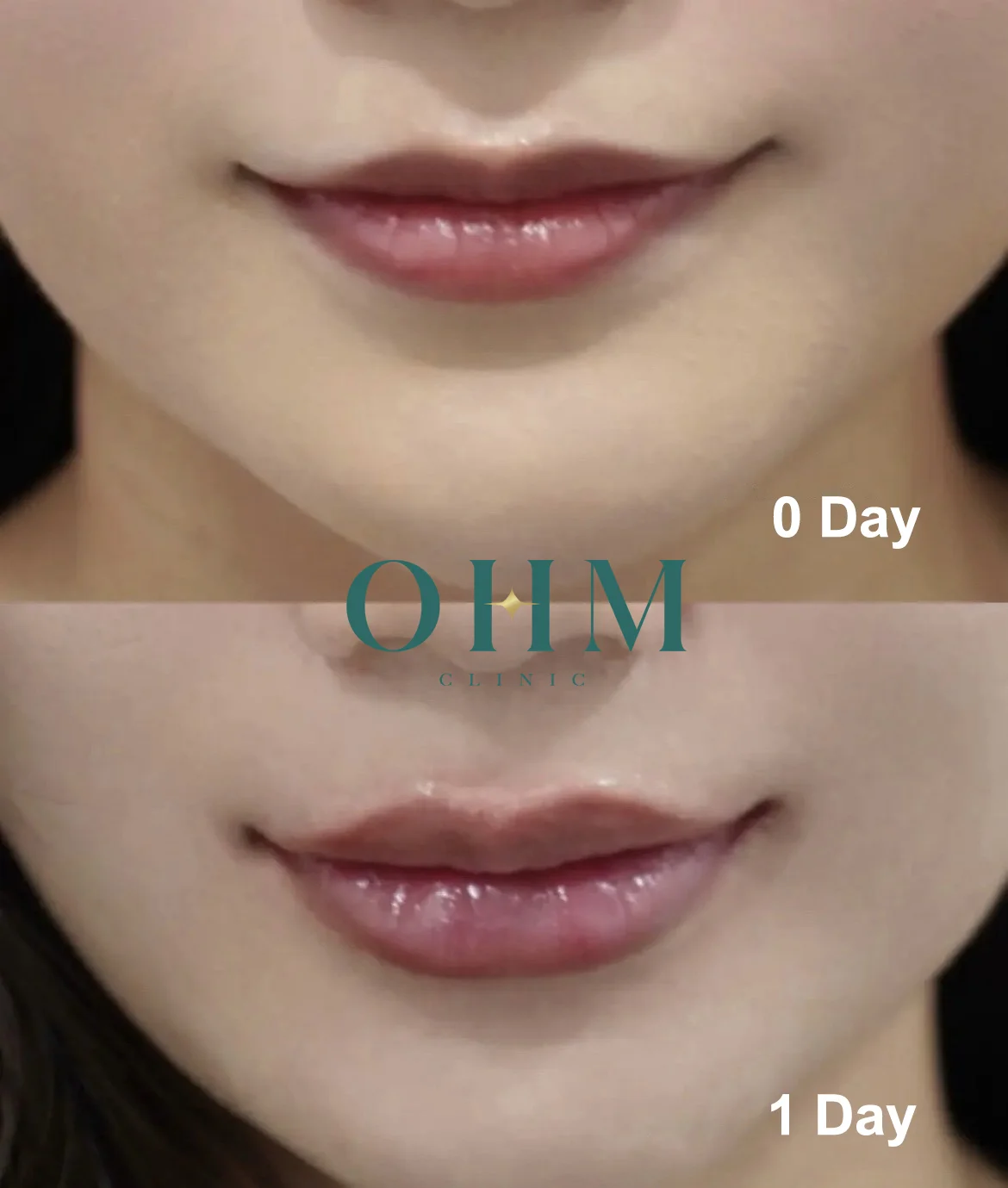 รีวิวฉีดฟิลเลอร์ปาก