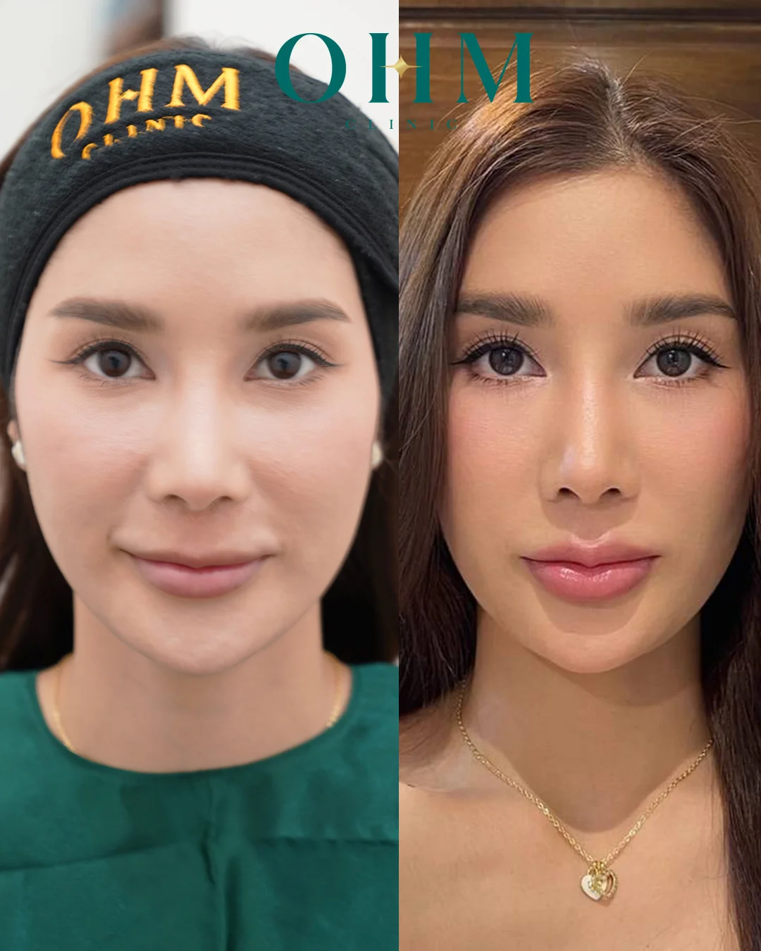 รีวิวฉีดปากทรงเกาหลี