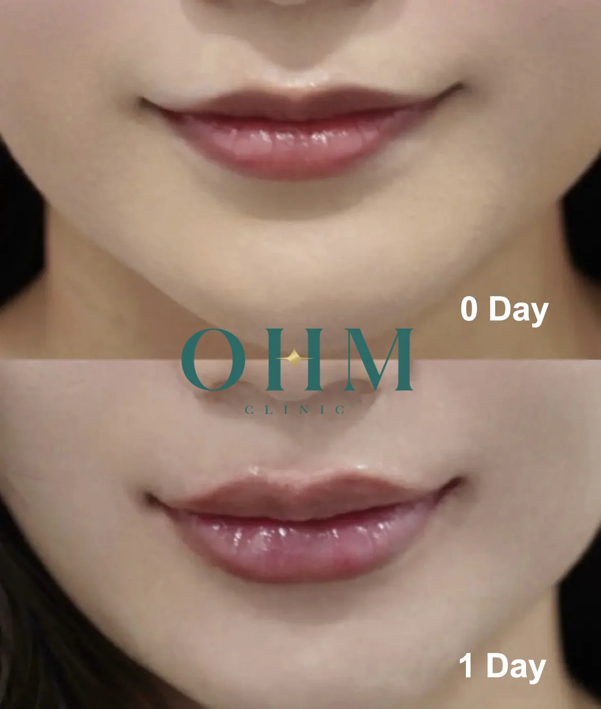 รีวิวฉีดปากทรงเกาหลี