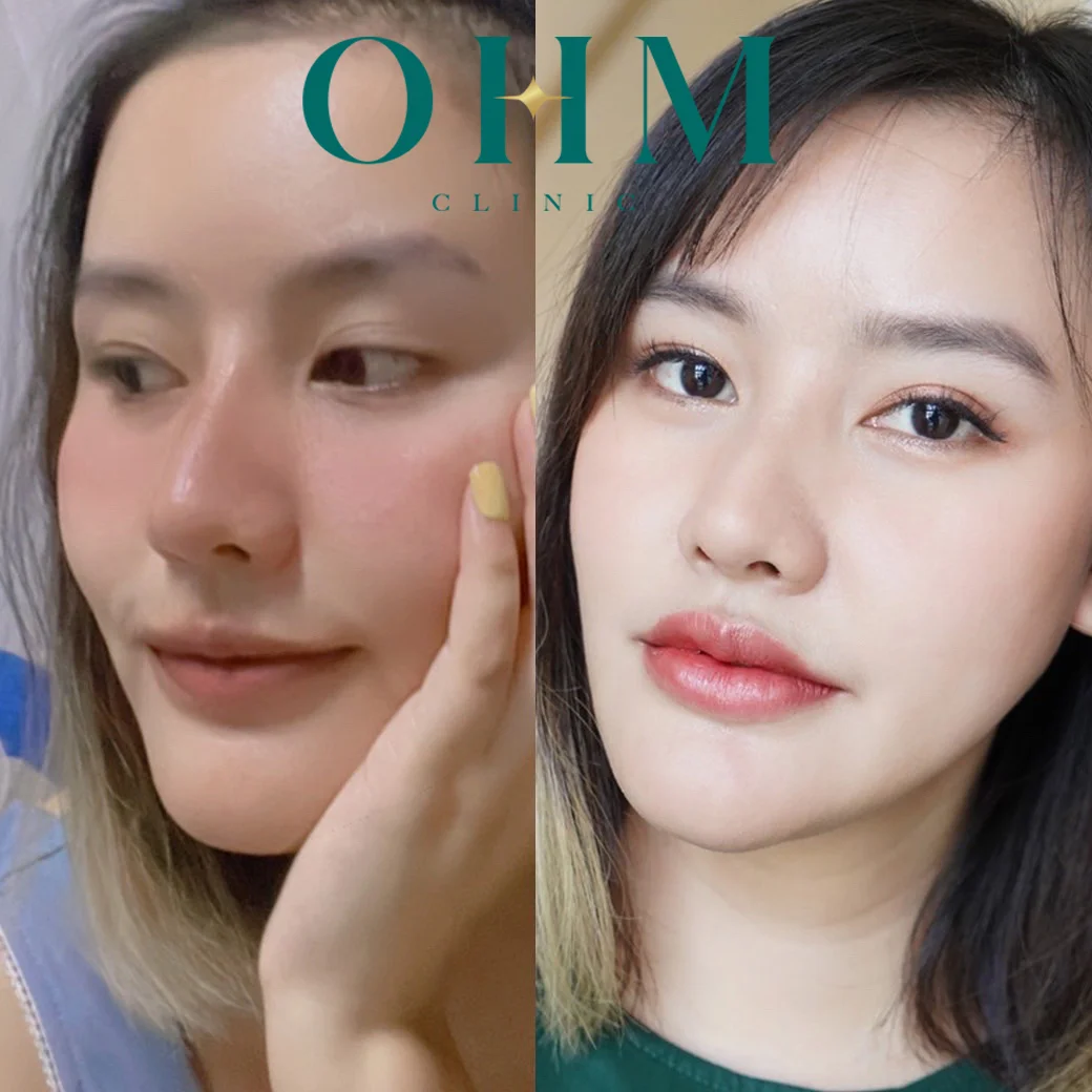 รีวิวฟิลเลอร์ปาก