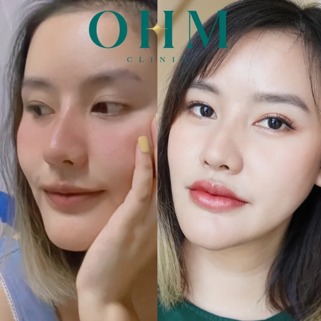 รีวิวฟิลเลอร์ปาก